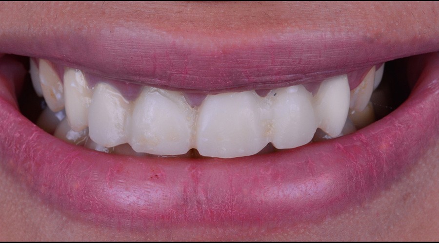 بعد تركيبات-اسنان